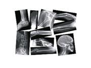 Roylco R 5914 Broken Bone Compound Fracture X Rays