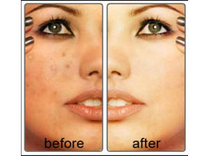 RETINOL A CREAM 0.1% 20g Anti Aging/Acne Cream/Wrinkle RETINOL A CREAM 0.1% 20g Anti Aging/Acne Cream/Wrinkle