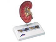 3B Scientific K29 Kidney Stone Anatomy Model