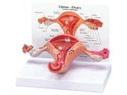 GPI Anatomical Uterus Ovary Cancer Model